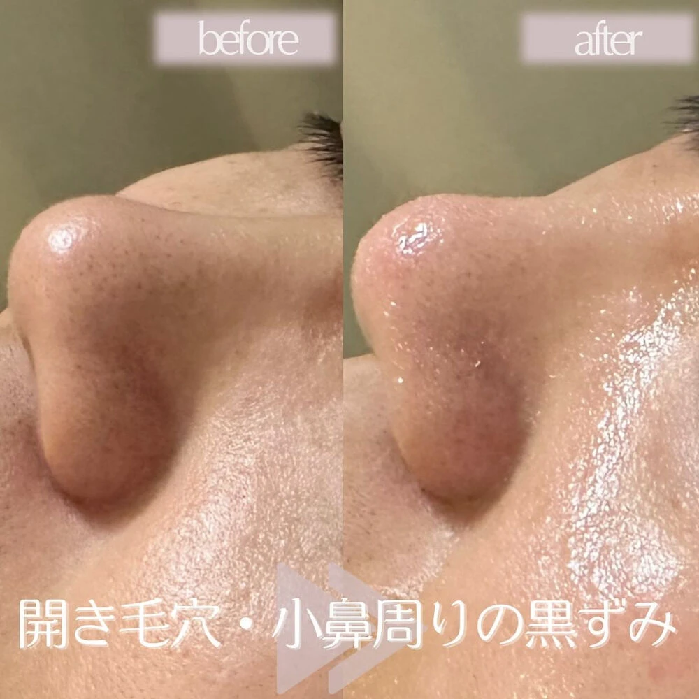 ブログ